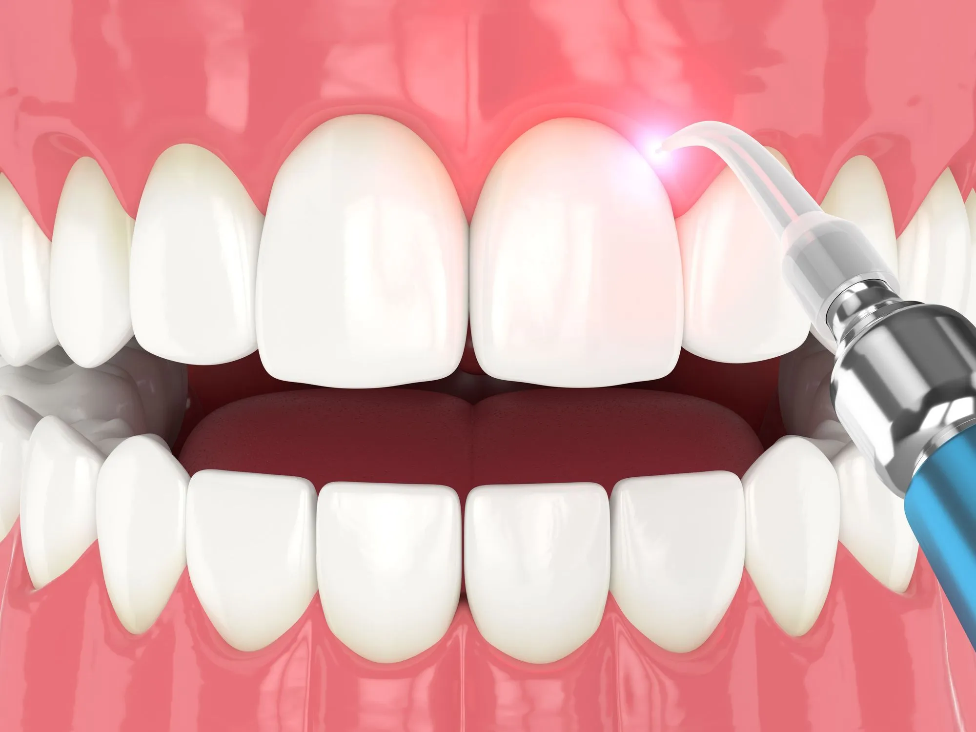 Dental Bonding