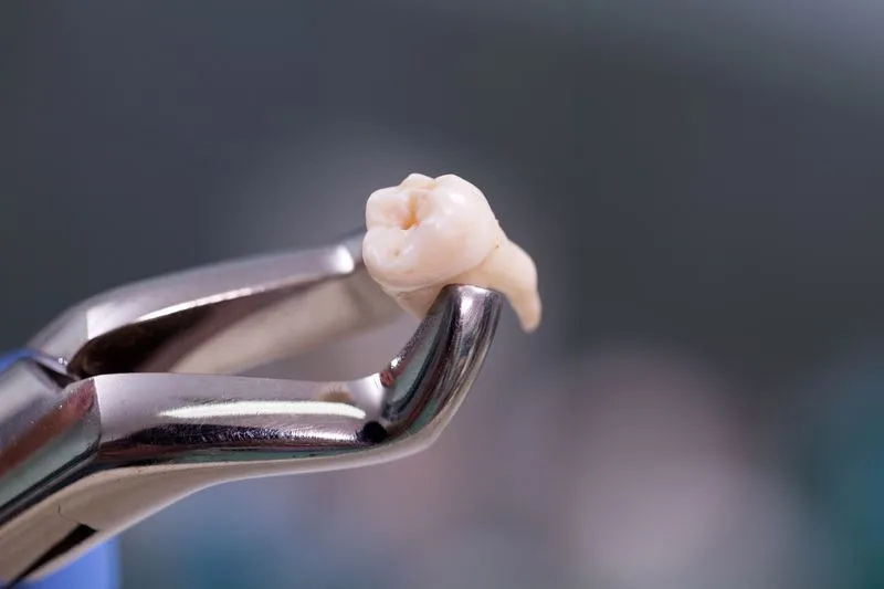 tooth extractions