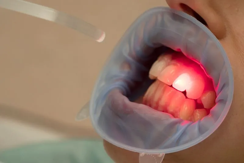 Soft-Tissue Laser Therapy