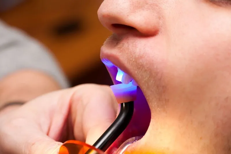 Dental Sealants