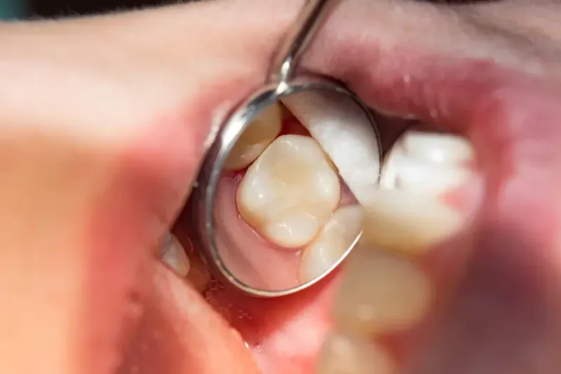 Dental Fillings