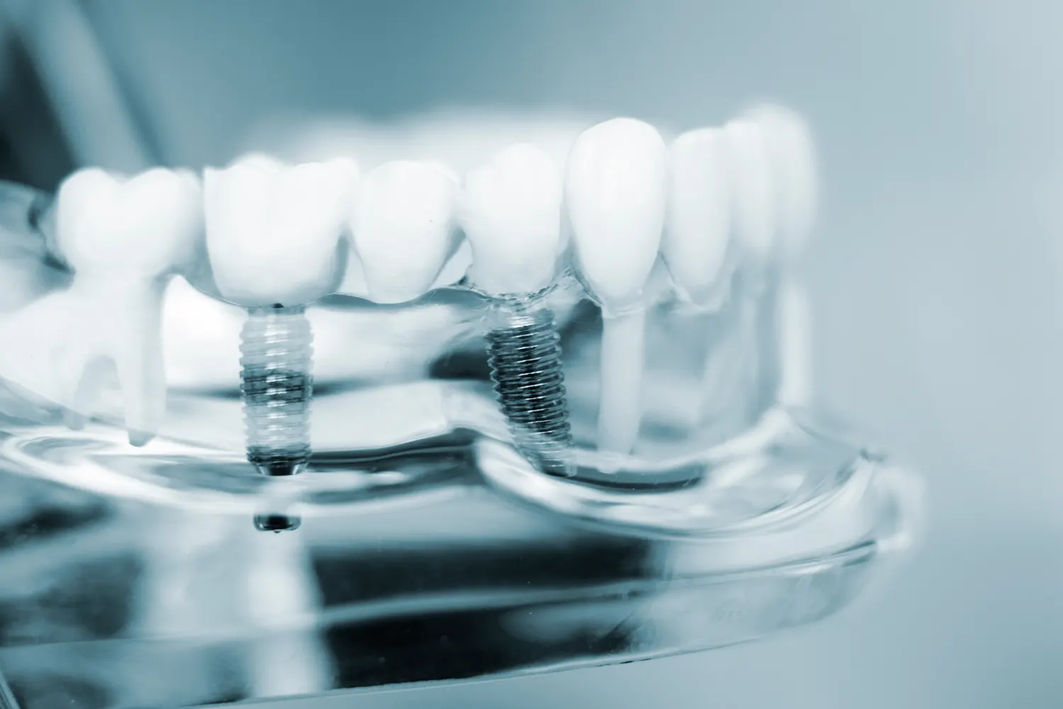 Dental Implants
