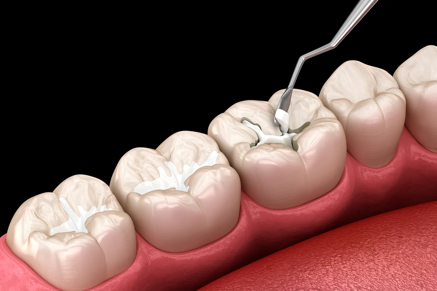 Dental Sealant