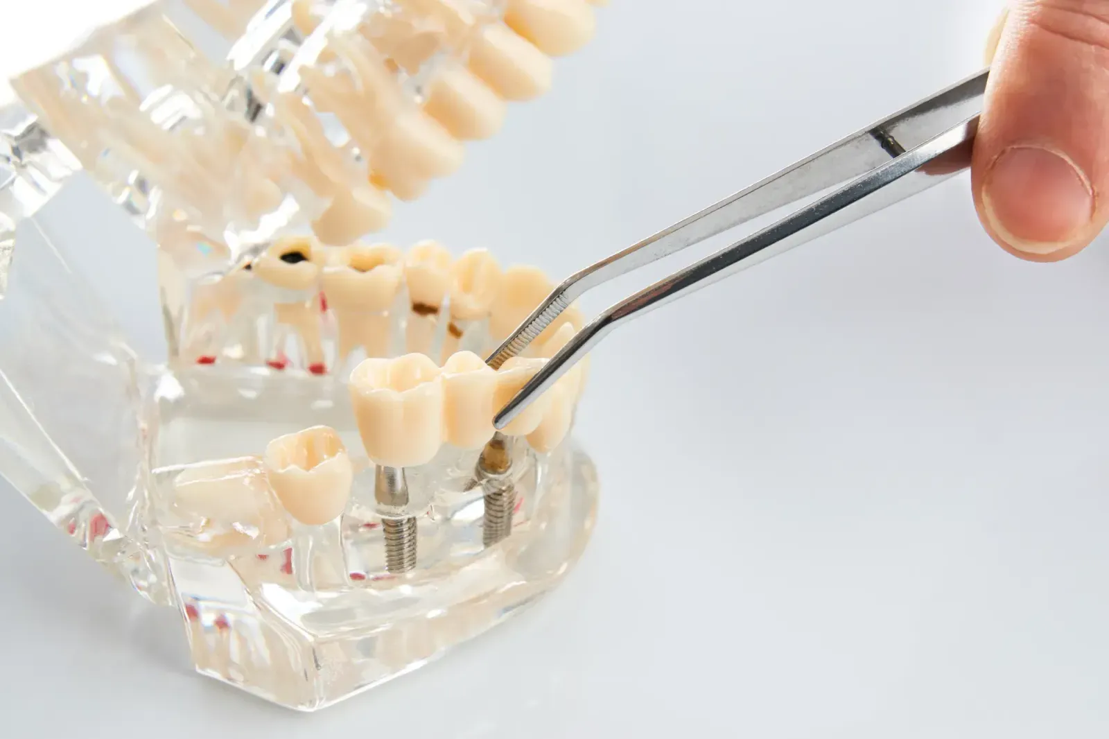Dental Implants