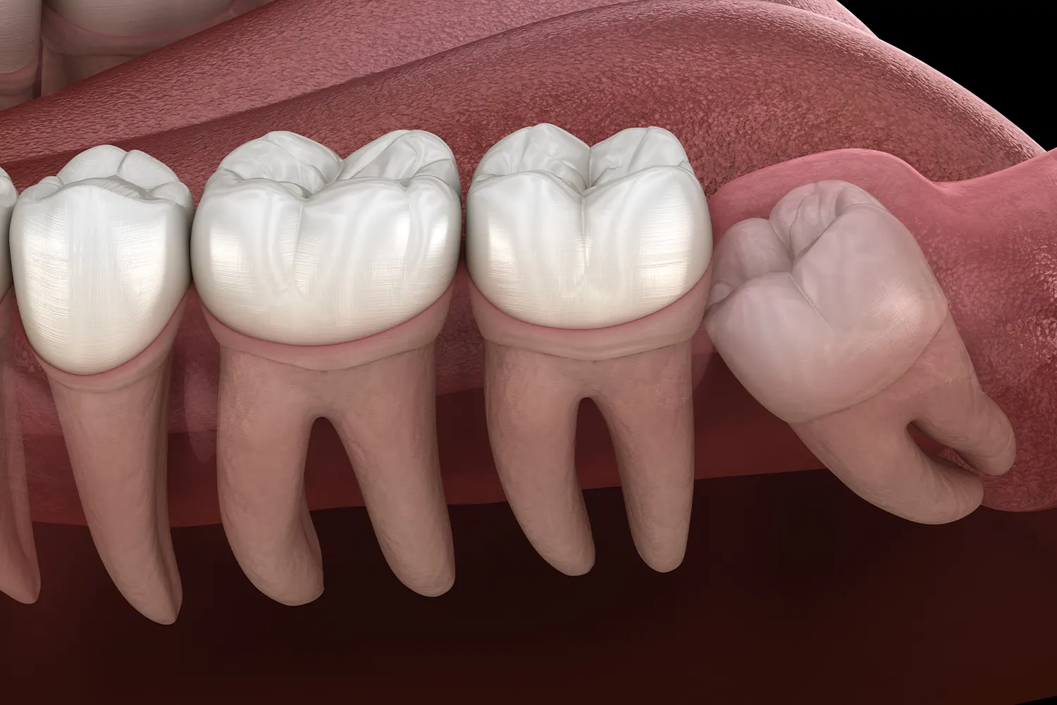 Wisdom Tooth Removal