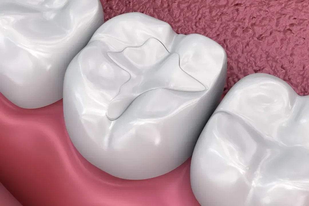Dental Fillings