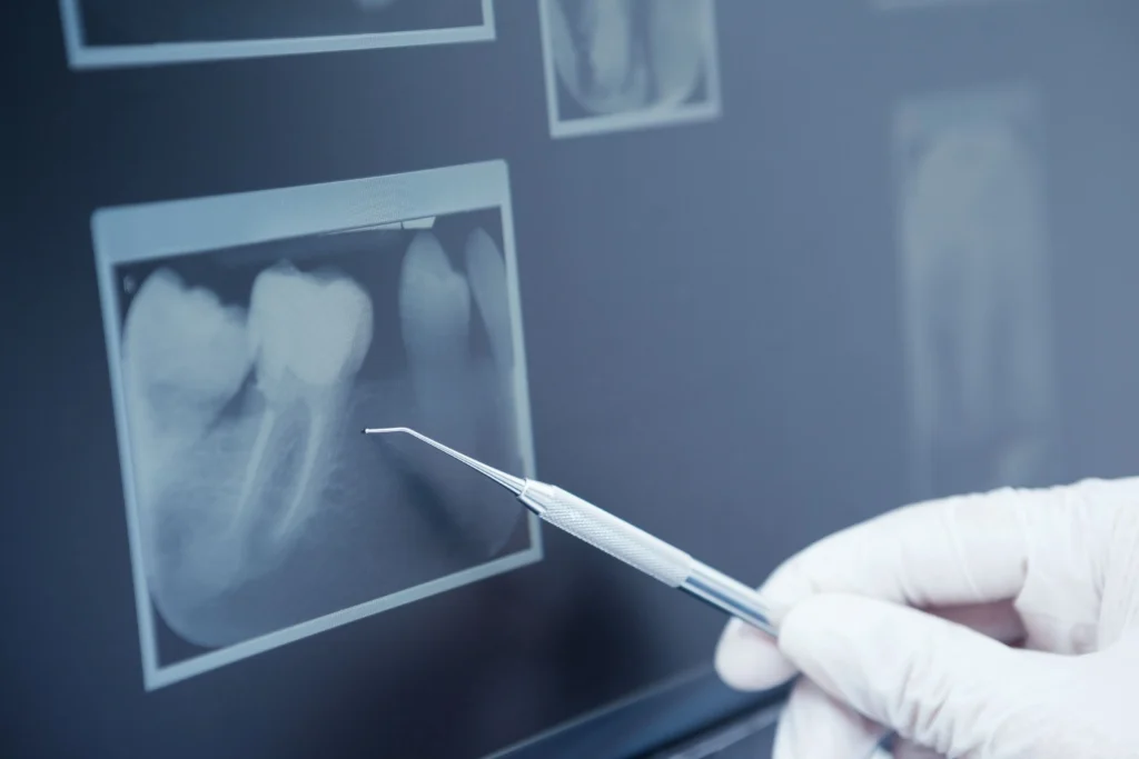 tooth xray