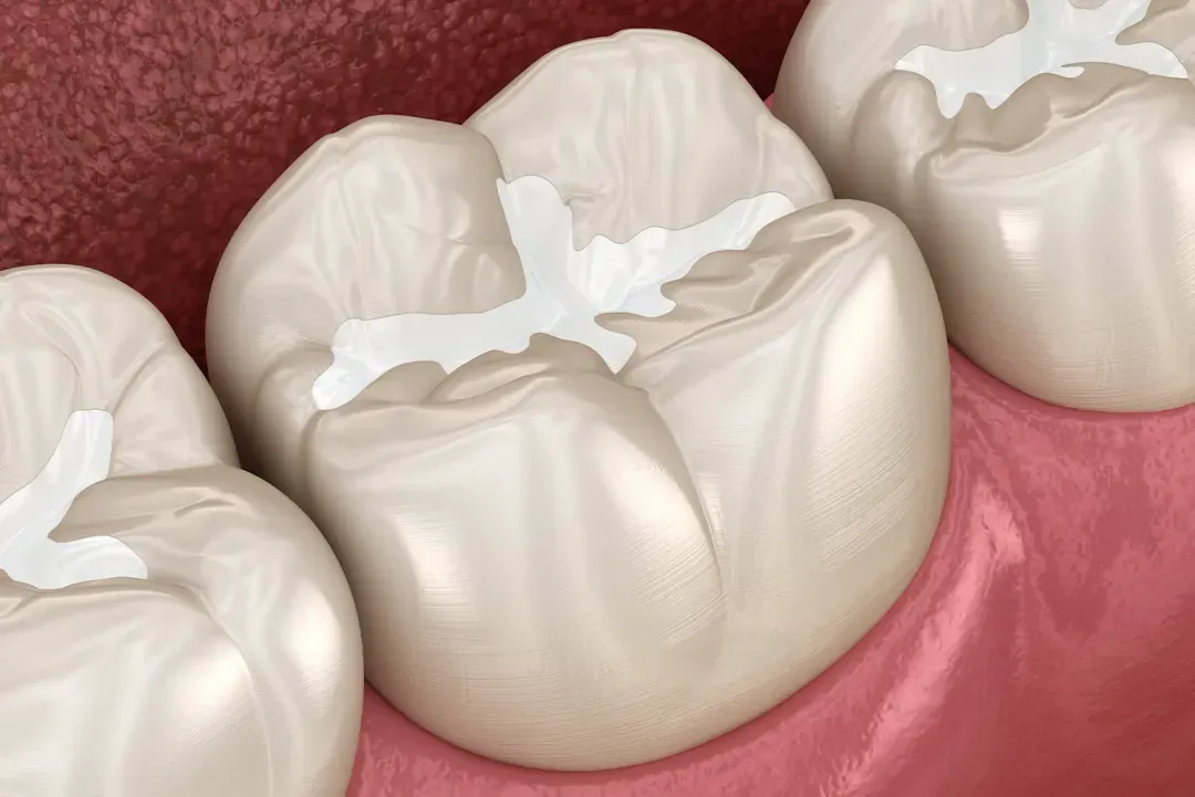 dental sealants