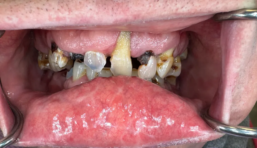 tooth decay