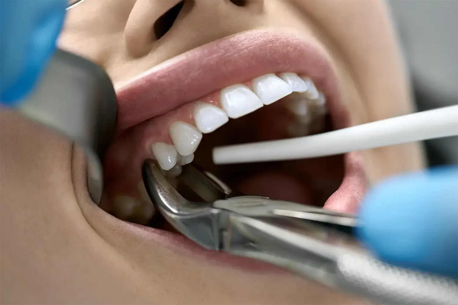 tooth extractions